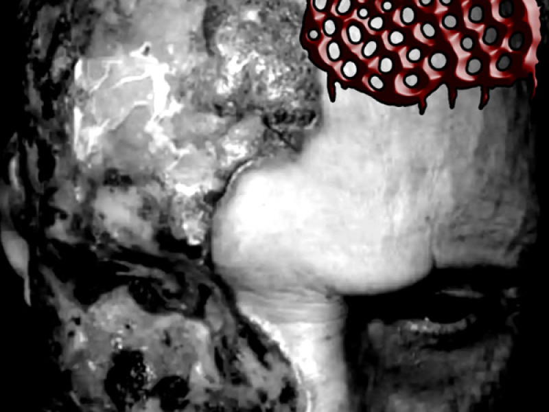 Apocrine Chromhidrosis - My Skin Is Infested With Mites And Covered In Shit (Single)